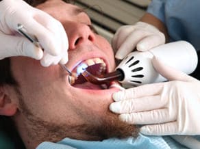 Dental Bonding Roswell GA