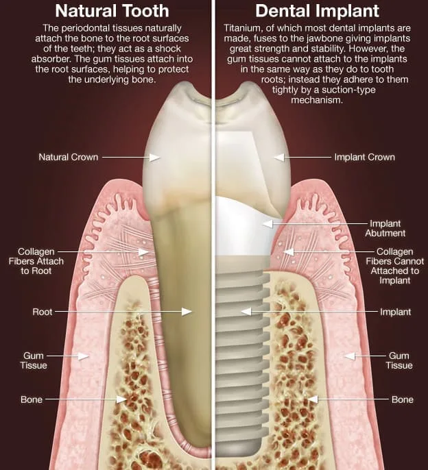 Dental Implant Roswell GA