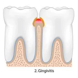 gum disease Treatment Roswell GA