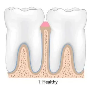 gum disease Treatment Roswell GA