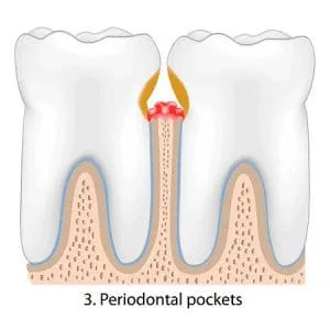 gum disease Treatment Roswell GA