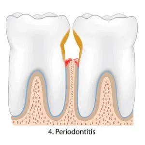 gum disease Treatment Roswell GA