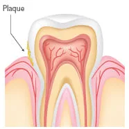 Periodontal Treatment Roswell GA