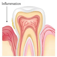 Periodontal Treatment Roswell GA